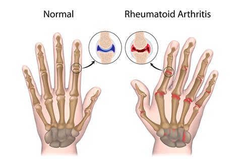 rheumatoid arthritis in older people.